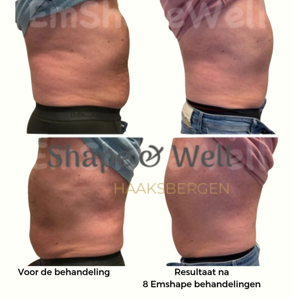 EMShape voor en na