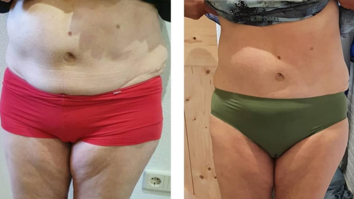 resultaten lymfopress